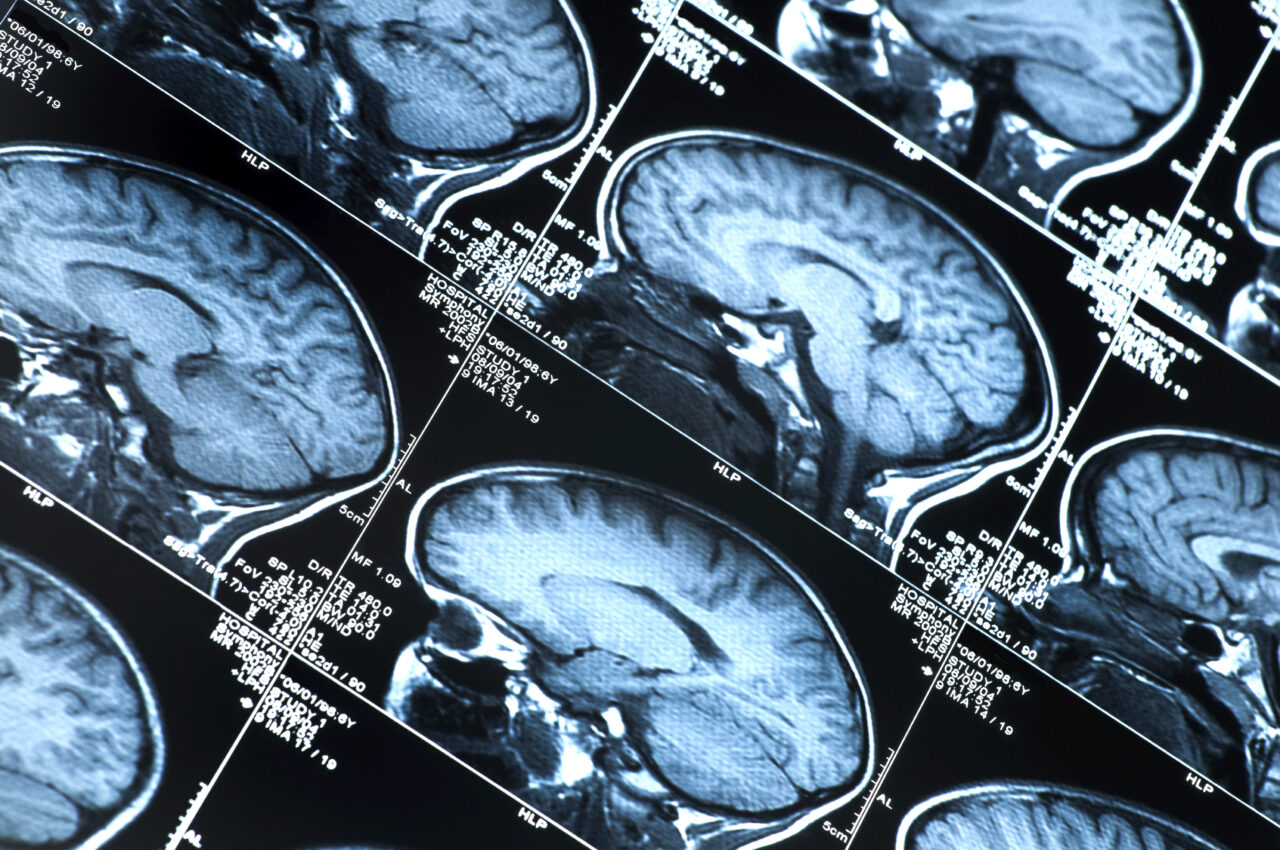 Stock image of brain x-ray